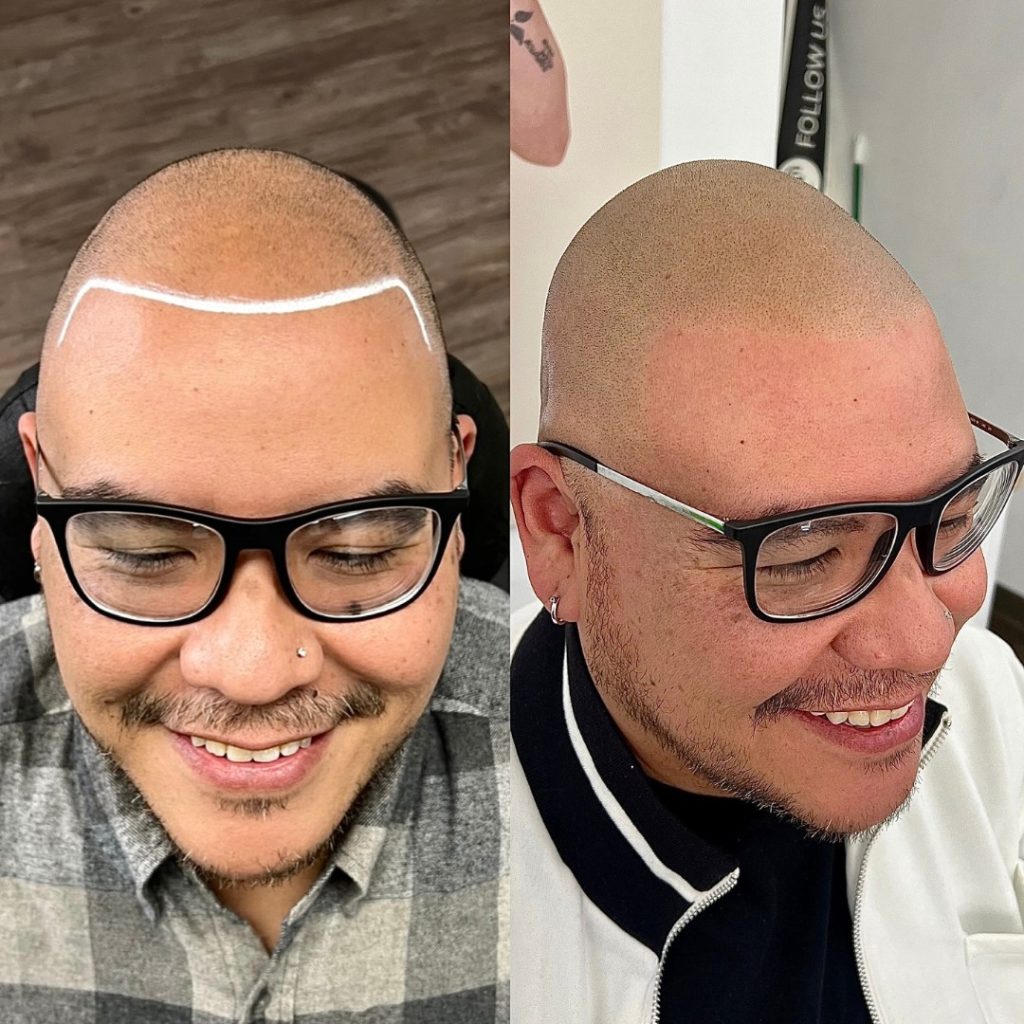 Derek Bogner Scalp Micropigmentation Los Angeles Scalp Micro Usa