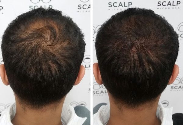 scalp micropigmentation density fill