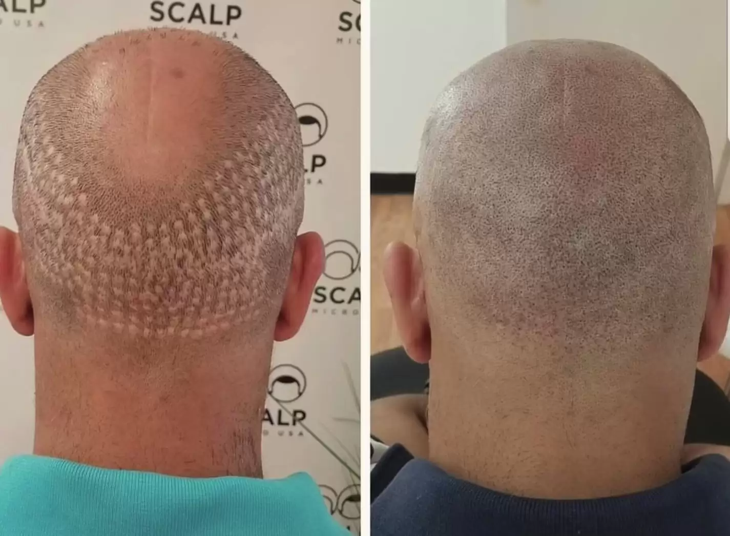 scalp micropigmentation hair transplant scar