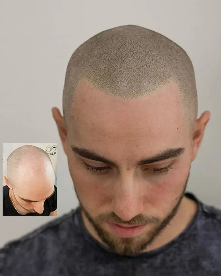 scalp micropigmentation hairline