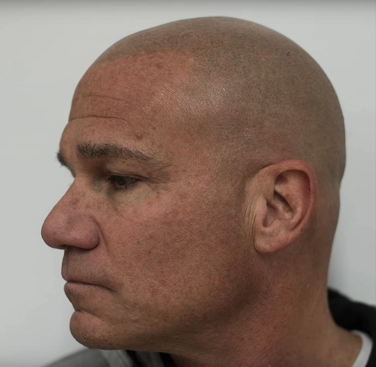 scalp micropigmentation near me