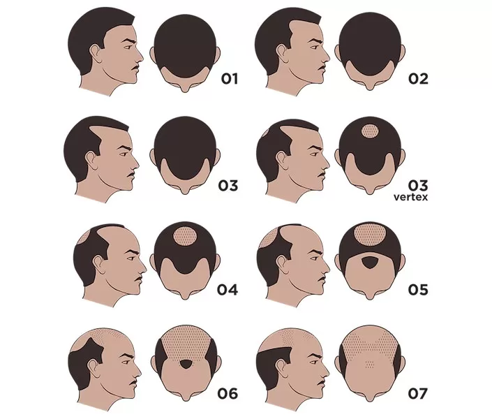 The Norwood Scale: Hair Loss Stages | Scalp Micro USA