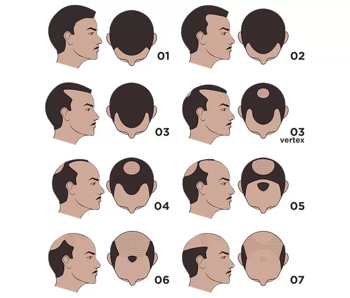 Ludwig scale  Types of hair loss – Neofollics