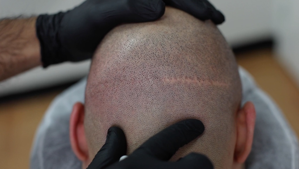 scalp micropigmentation cover up hair transplant scars