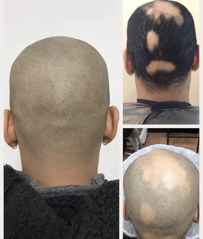 alopecia scalp micropigmentation and gray hair