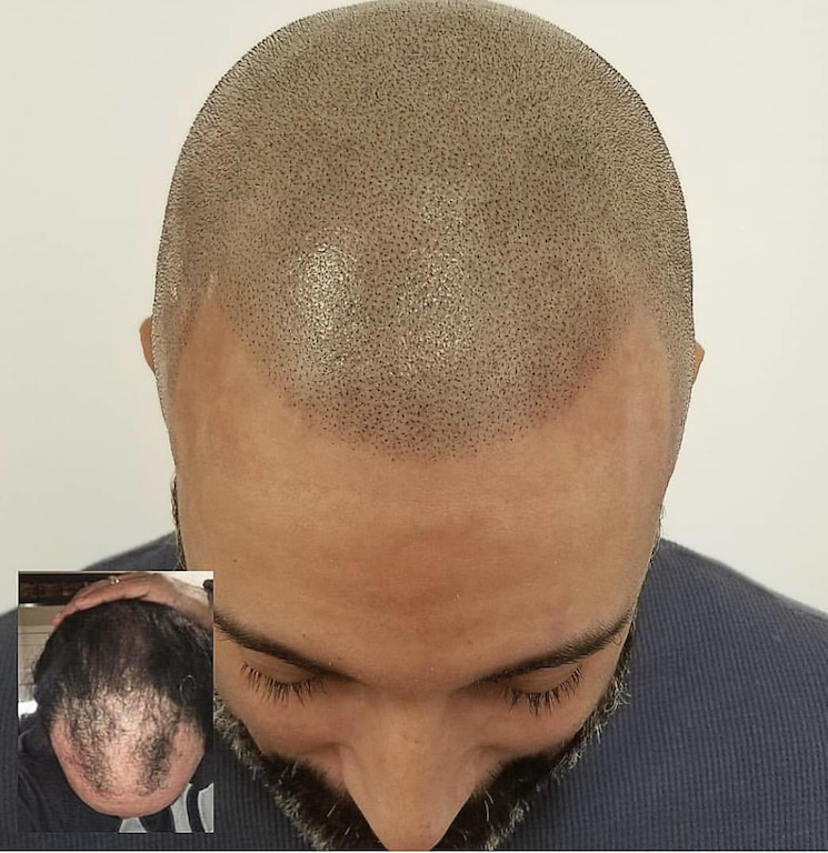 scalp micropigmentation grey hair