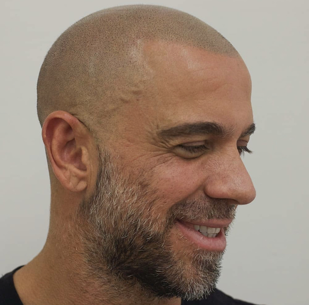 scalp micropigmentation grey hair