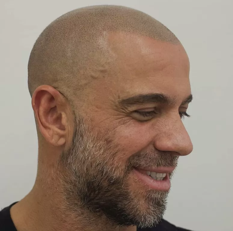 scalp micropigmentation with gray hair