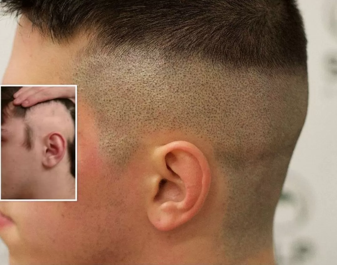 scalp micropigmentation pattern baldness