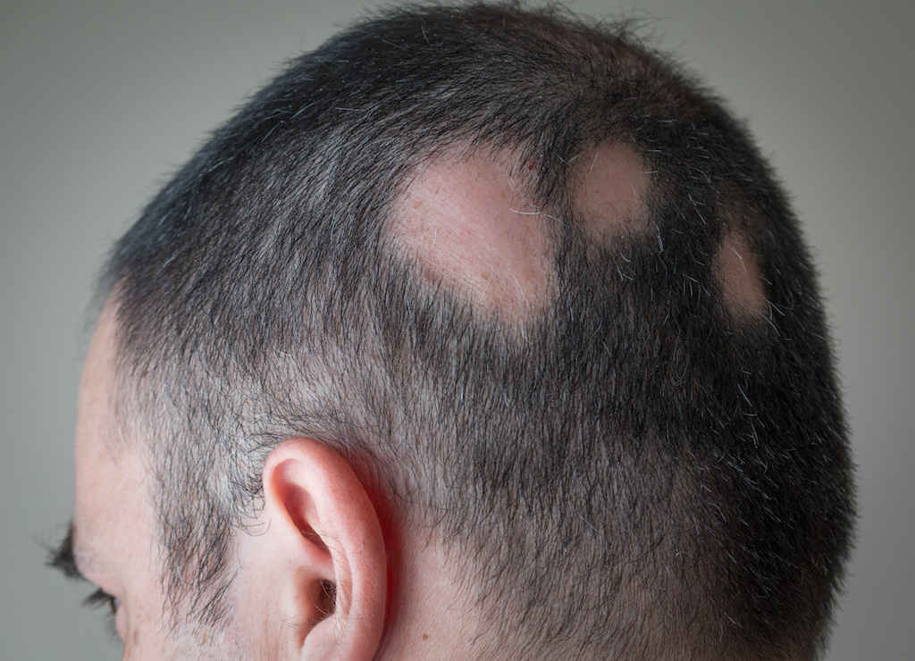 Alopecia Aerata scalp micropigmentation