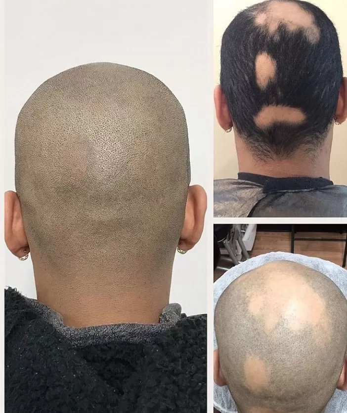 Blog – Scalp Micropigmentation Houston, San Antonio, Austin, Texas HTX ATX  SATX