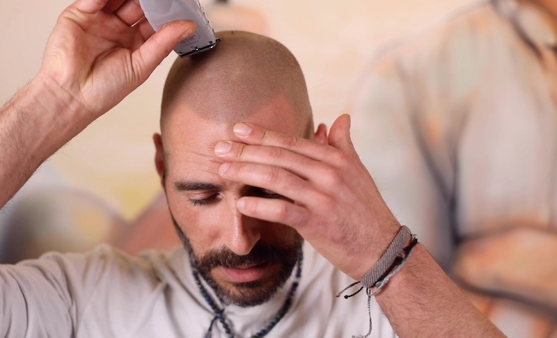 scalp micropigmentation treatment
