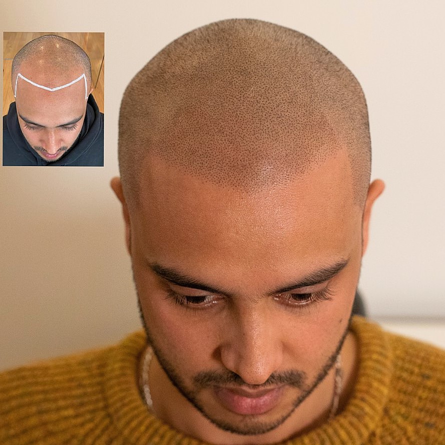 best scalp micropigmentation results