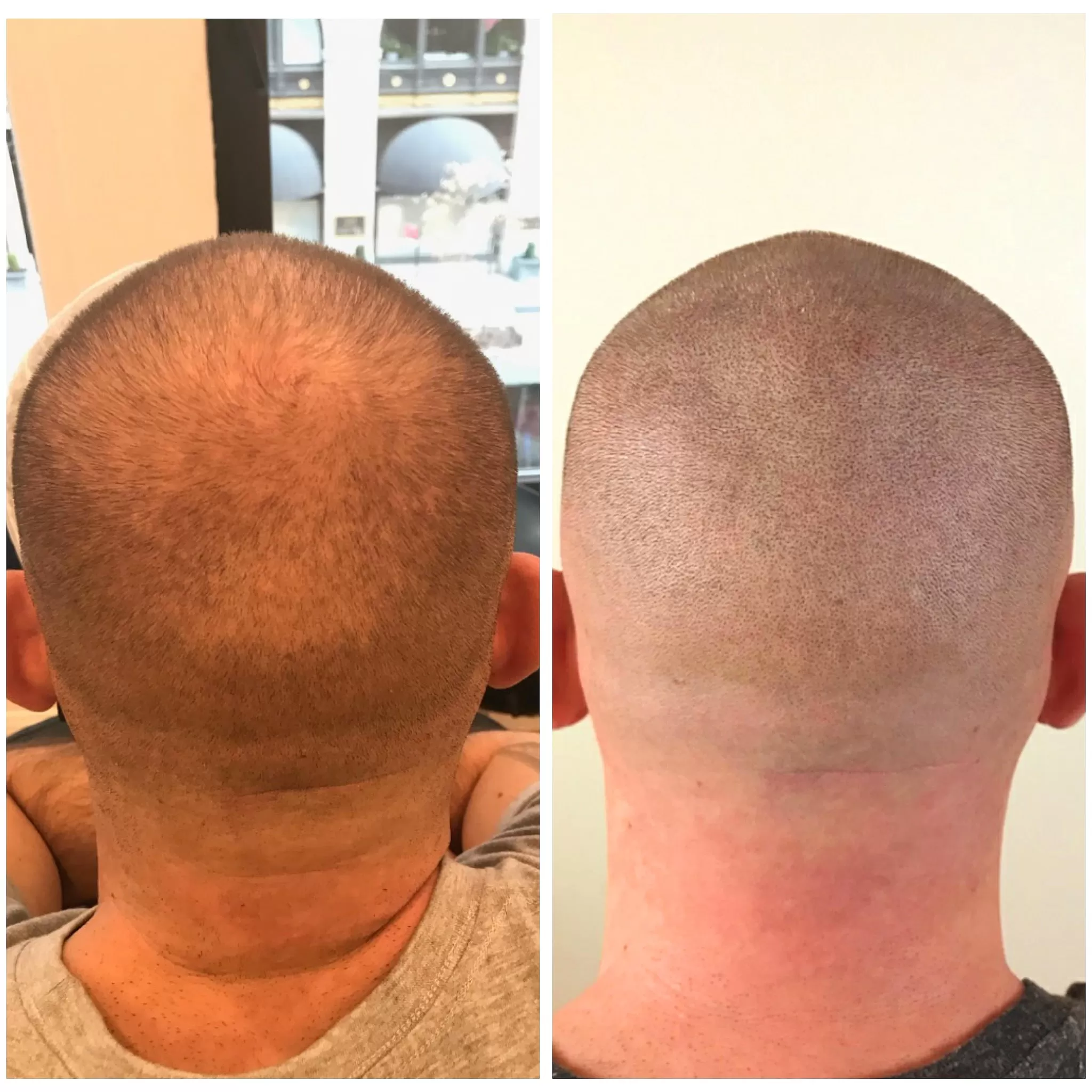 scalp micro usa crown thinning