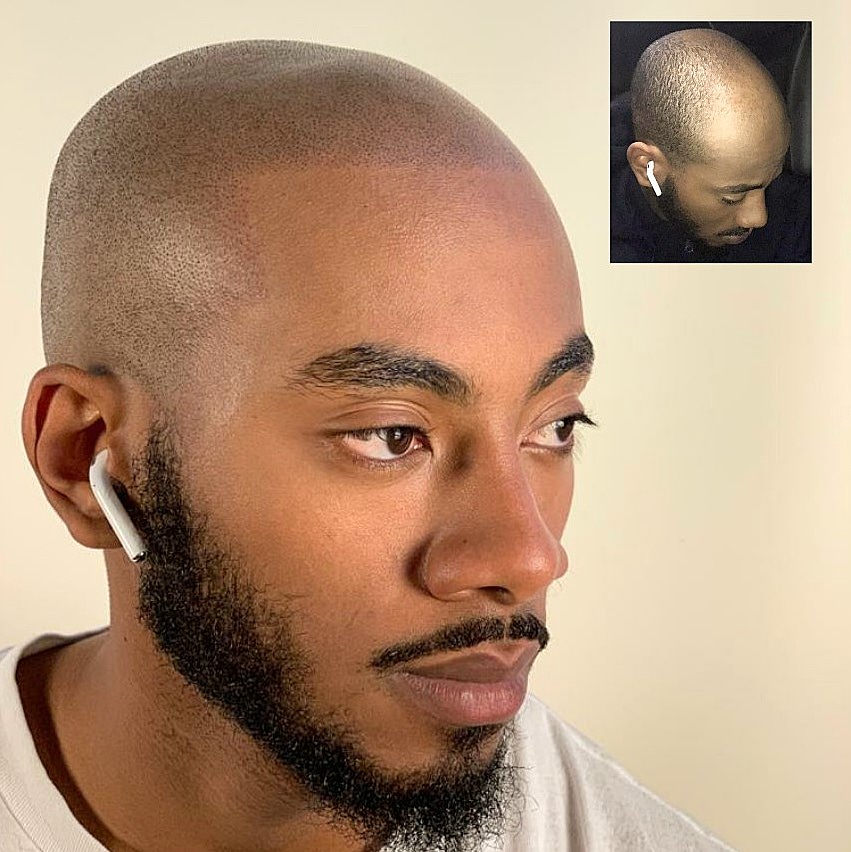 Scalp Envy Micropigmentation