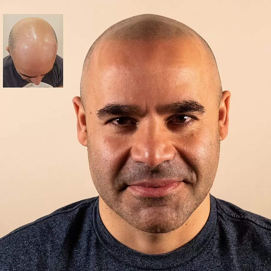 scalp micropigmentation houston