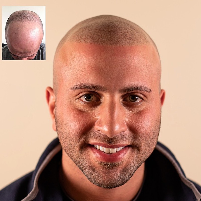 scalp micropigmentation los angeles