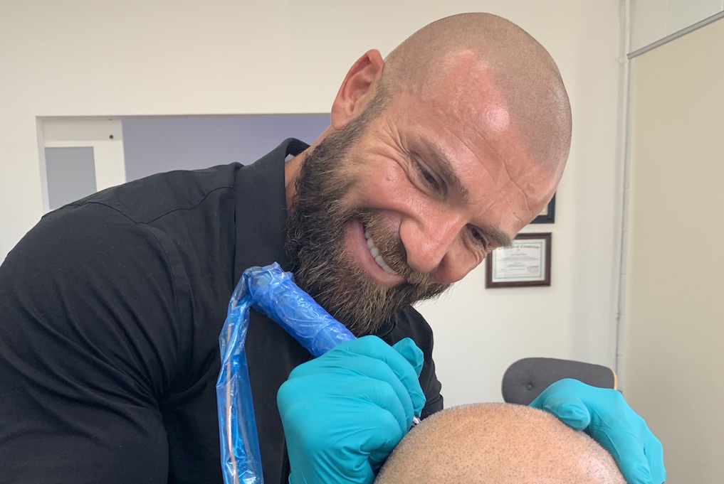 scalp micropigmentation los angeles california