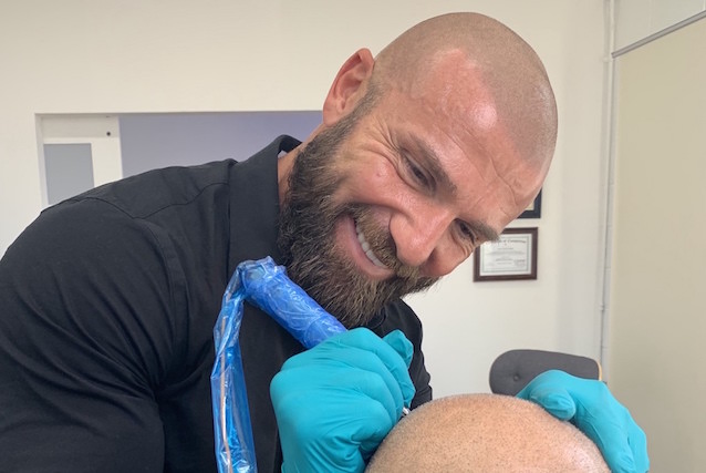 scalp micropigmentation los angeles california