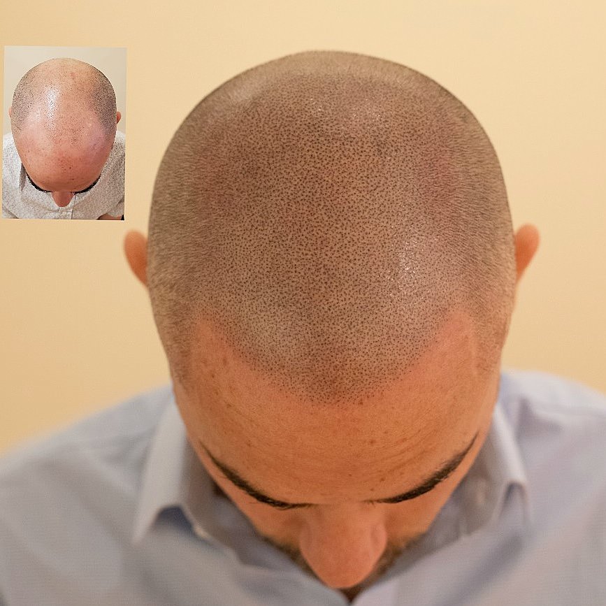 scalp micropigmentation