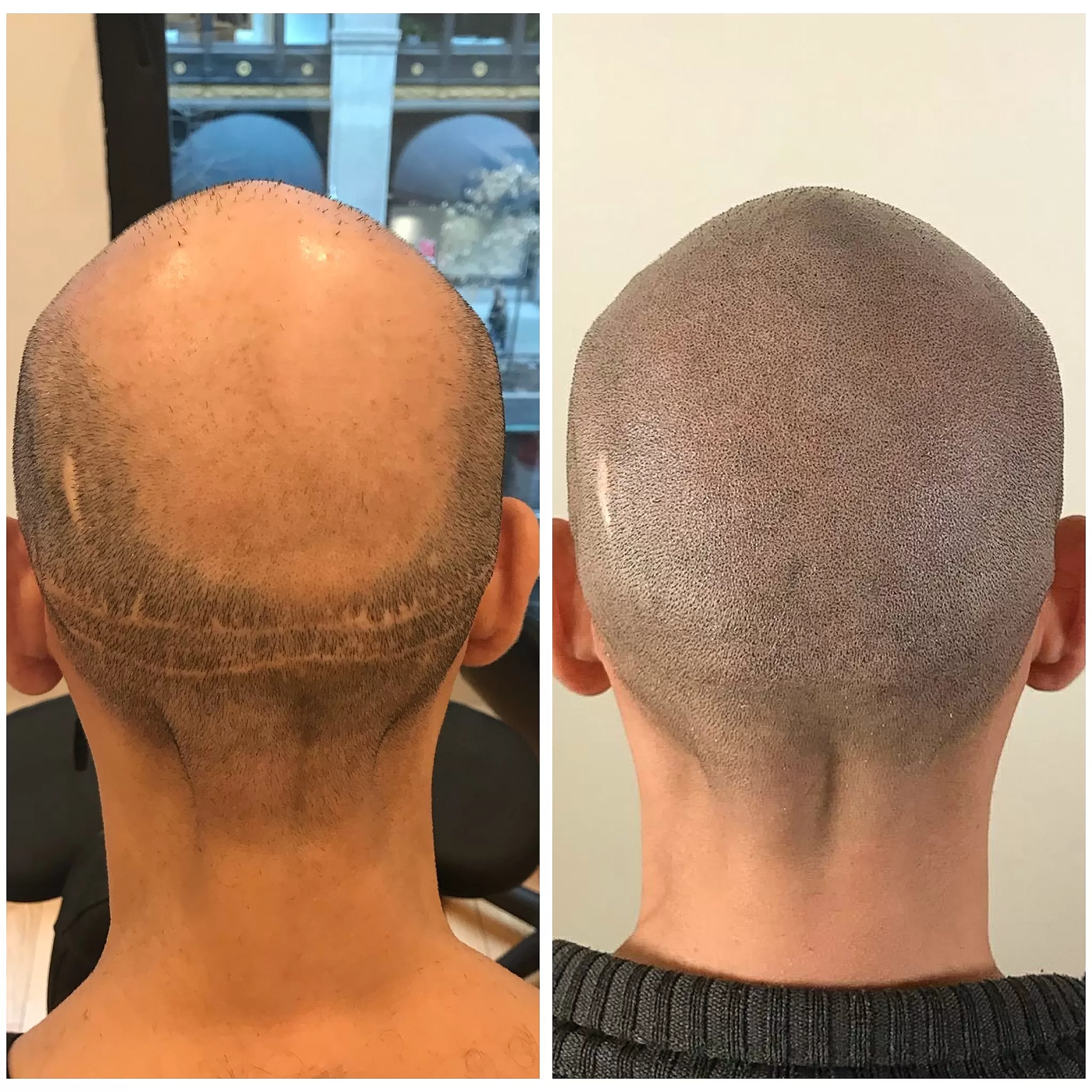 scalp tattoo for hair transplant scars