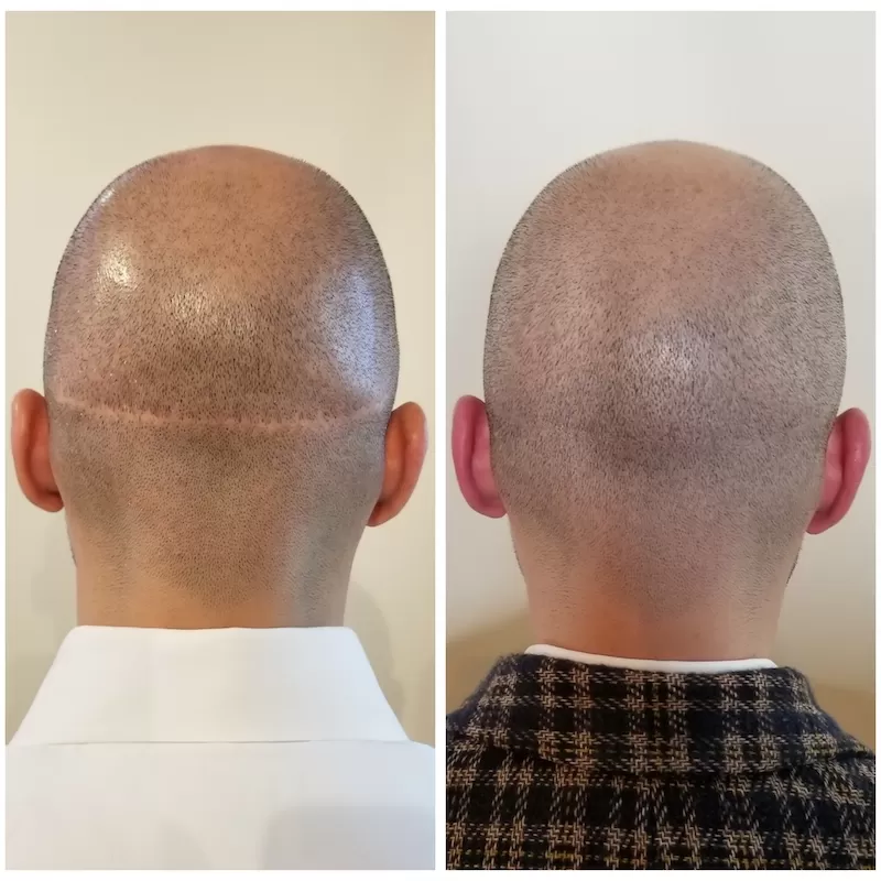 scalp micropigmentation scars