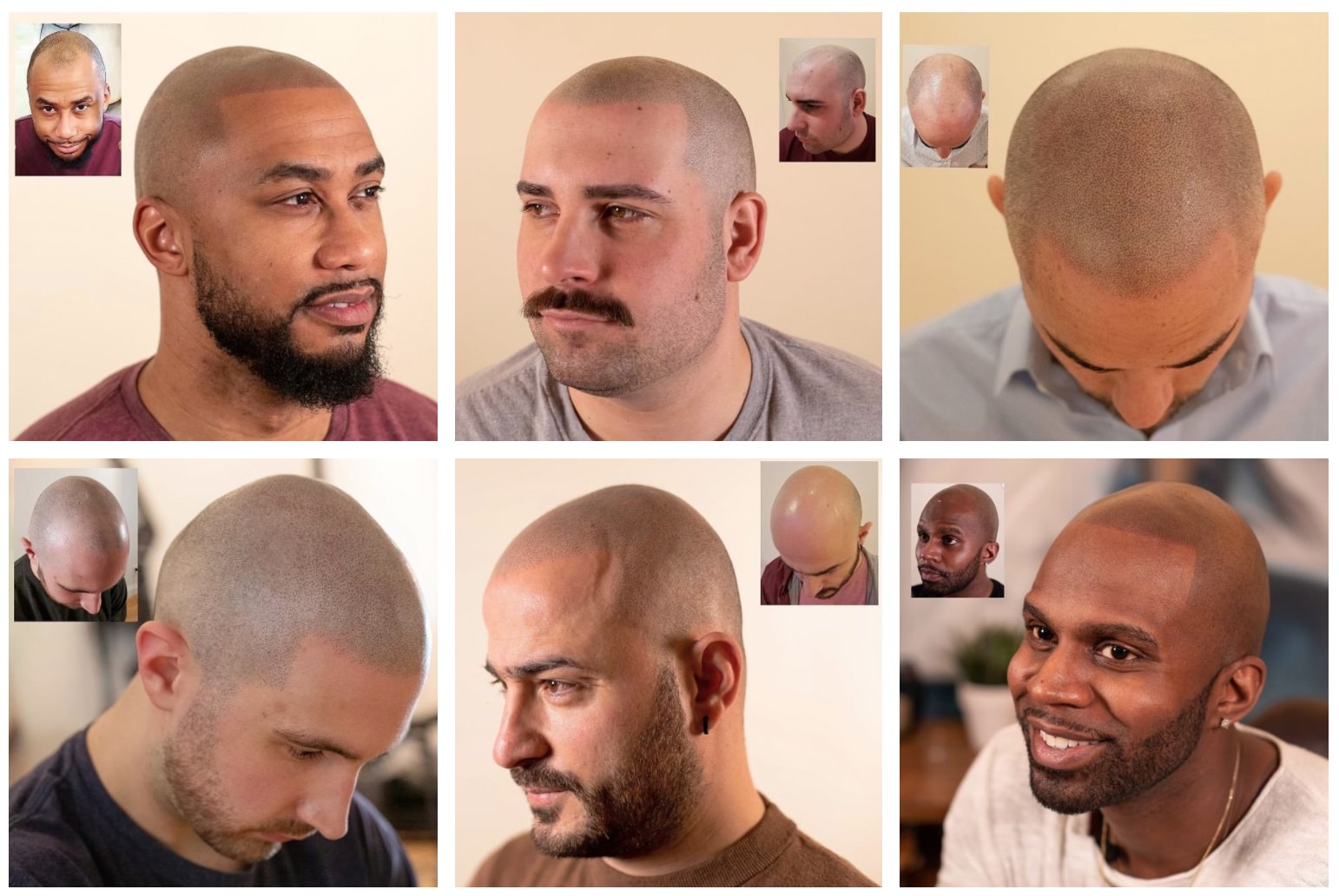 scalp micropigmentation hairlines