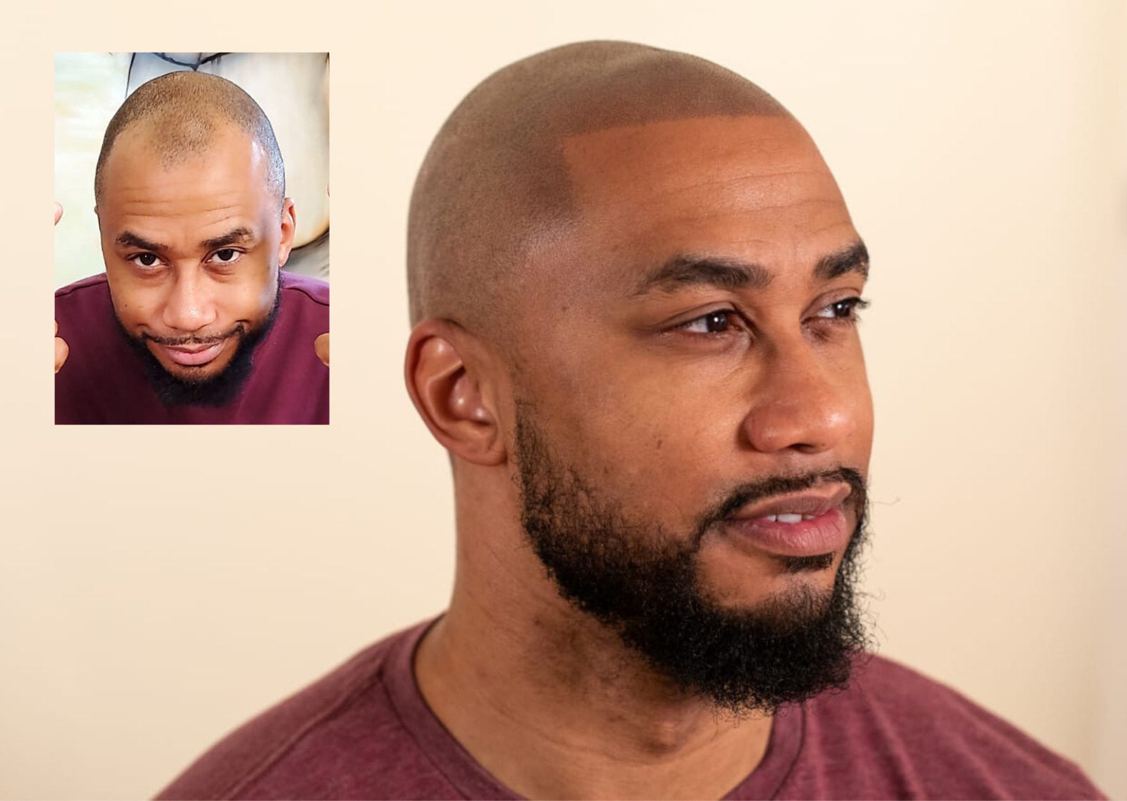 How long does scalp micropigmentation last? - Scalp Micro USA