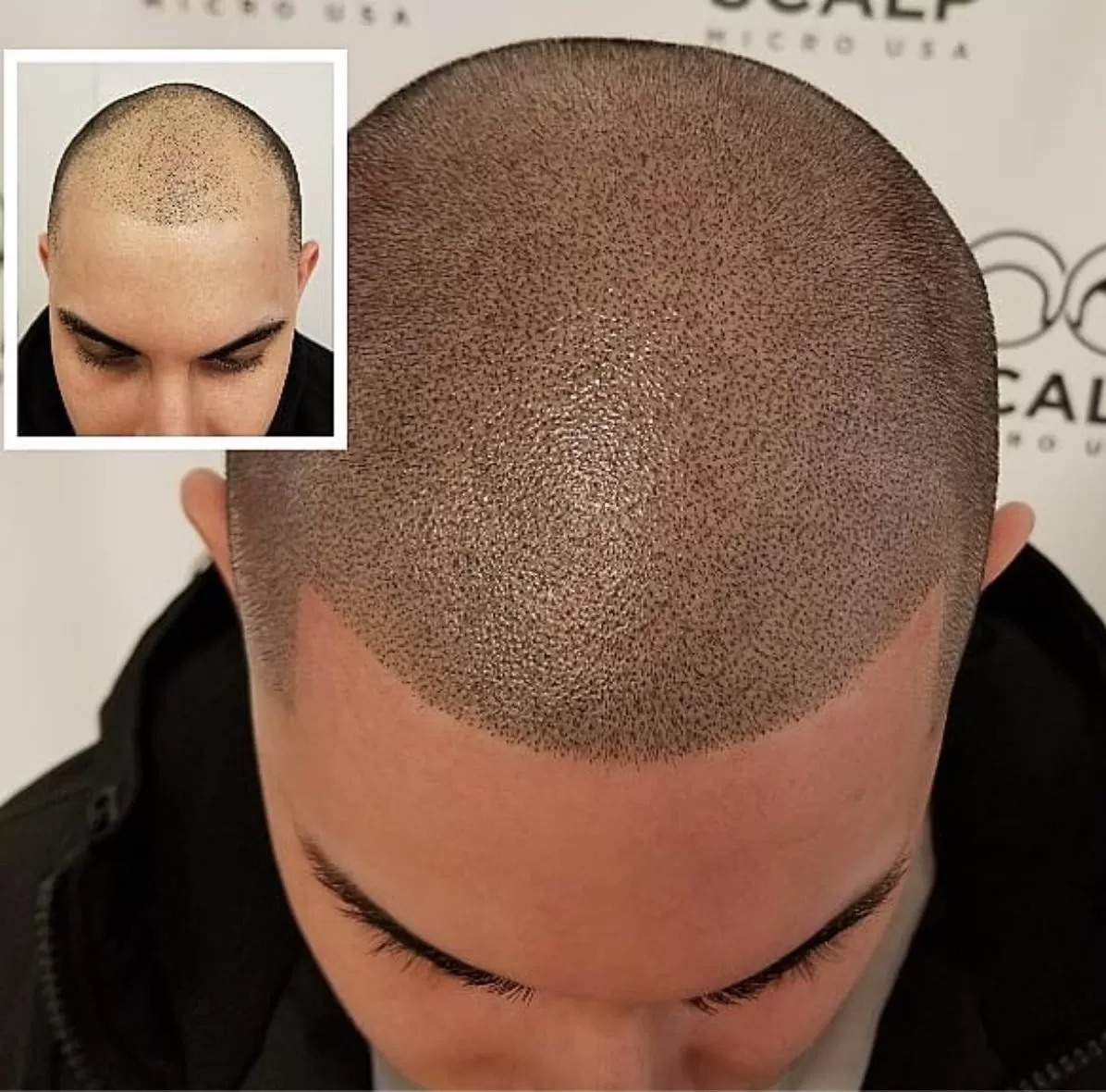 scalp micropigmentation hair pigmentation