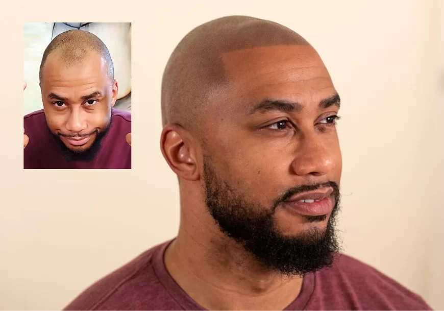 Top Questions Answered About Scalp Micropigmentation  SMP