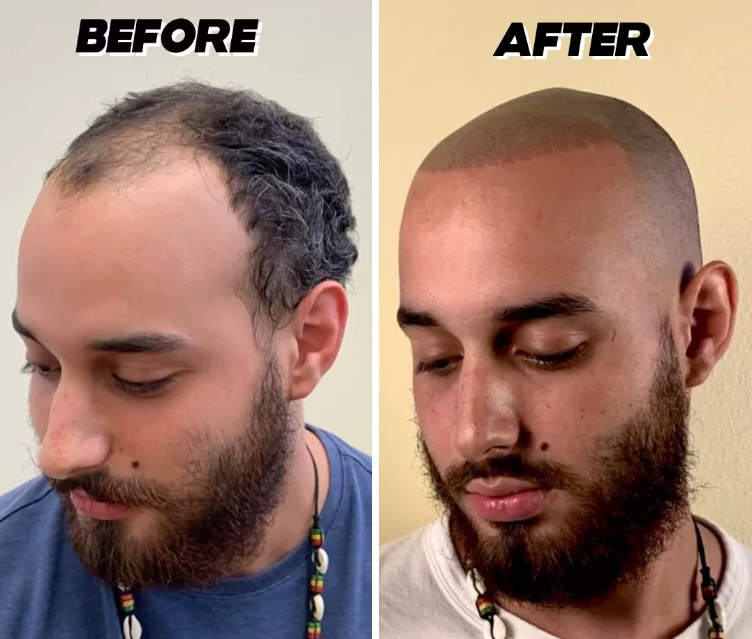 scalp micropigmentation hair loss nyc houston los angeles