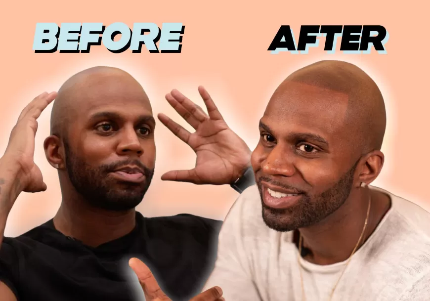 scalp micropigmentation reviews