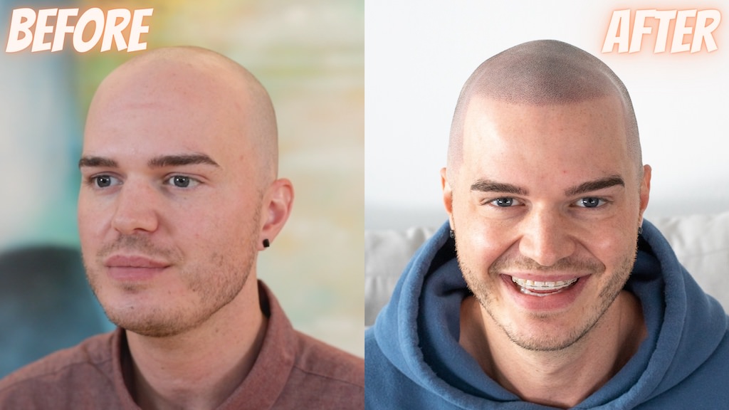 scalp micropigmentation before and after