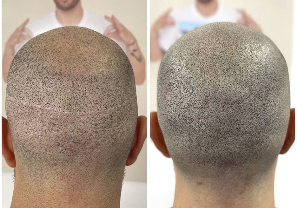 Miami Scalp Micropigmentation | Palm Beach Hair Loss Options