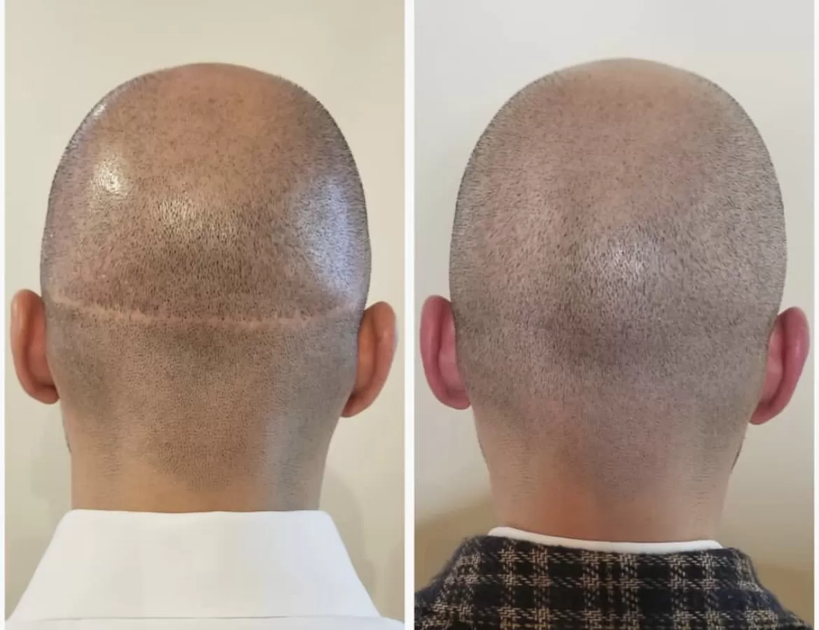 scalp micropigmentation scar camouflage