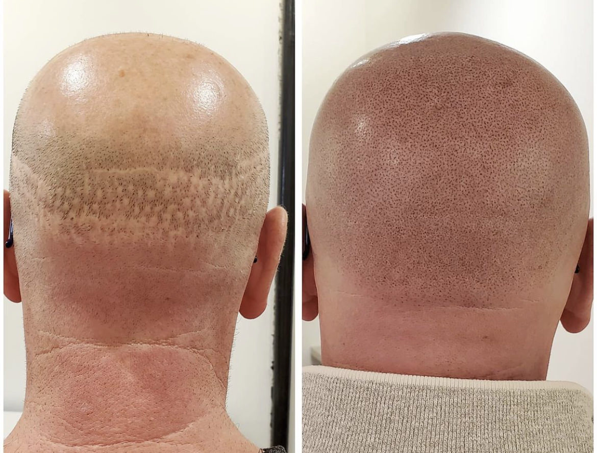 scalp pigmentation fue fut scar