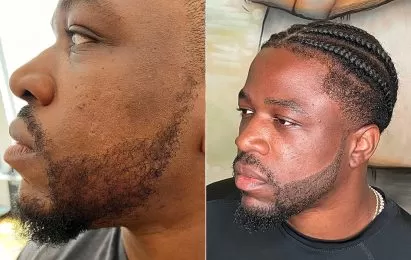 beard enhancement micropigmentation