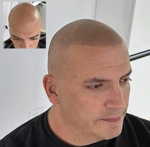 Danny Horal Scalp Micropigmentation Florida Scalp Micro USA