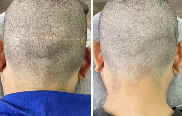 💎 Scalp Micropigmentation 💎 Before and After - YouTube