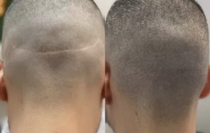 Scar-camouflage-scalp-micropigmentation-fut-tattoo-miami-los-angeles-chicago-nyc