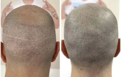 Scar-camouflage-scalp-micropigmentation-hairline-miami-los-angeles-chicago-nyc
