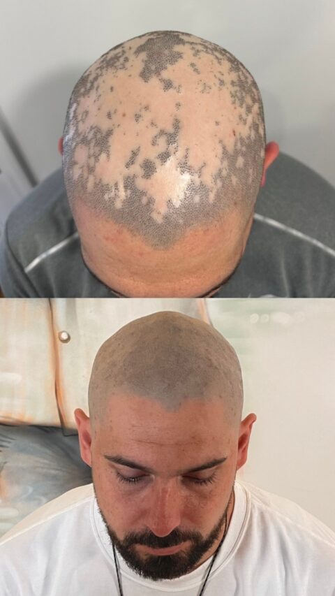 Scalp Micropigmentation hair loss tattoo: ✓ See immediate results ✓ N... |  TikTok