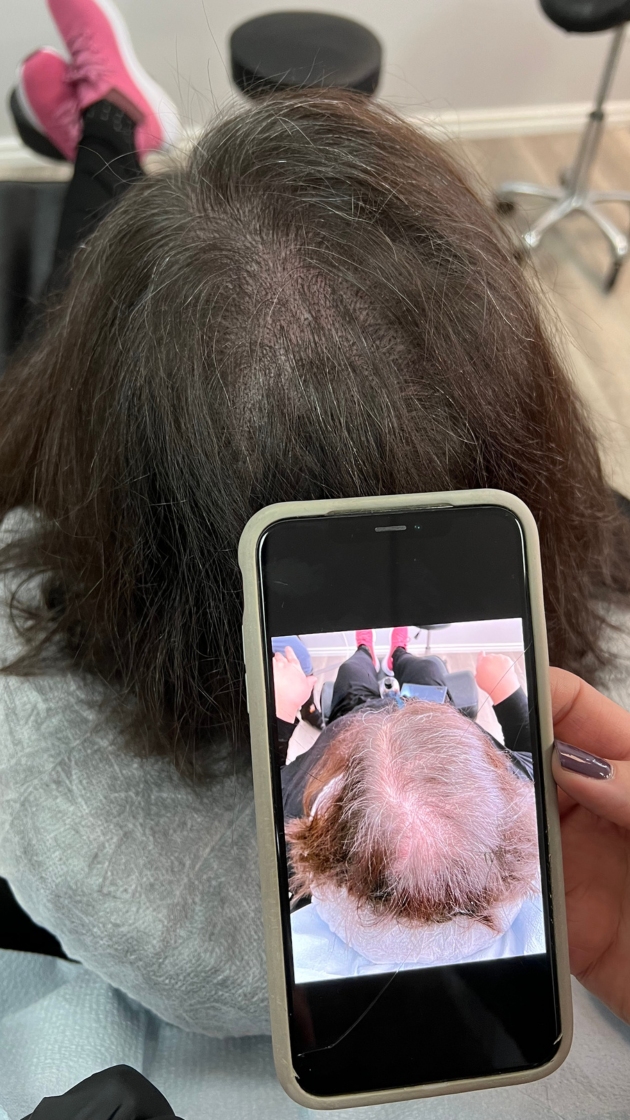 Female Hair Loss Treatment Scalp Micro USA