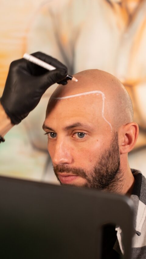 hair loss scalp micropigmentation