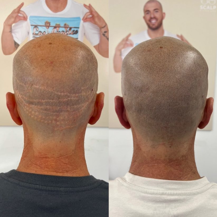 hair transplant fue fut strip scar help