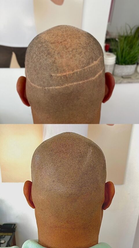 hair transplant scalp micropigmentation