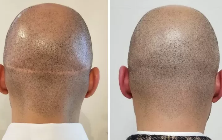 hair transplant scar camouflage