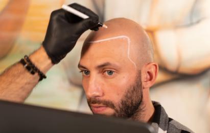 scalp micropigmentation hairline