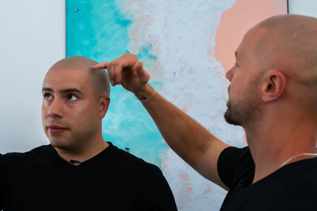 scalp-tattoo-california-scalp-micropigmentation-hairline-tattoo