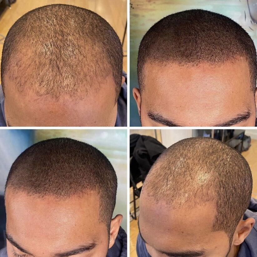 density fill for male hair loss